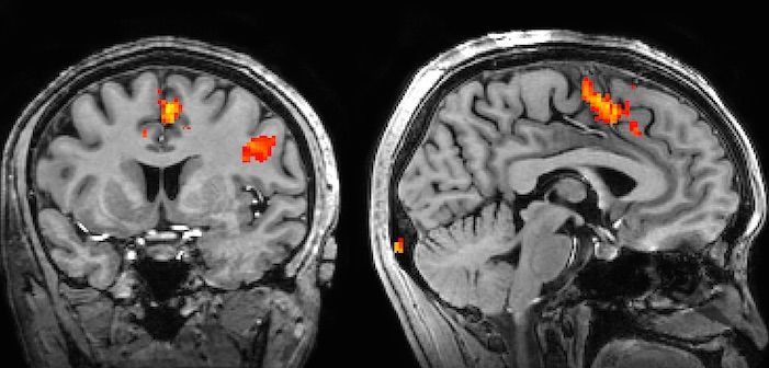 categories of neural prostheses: central nervous system, or peripheral nervous system, invasive or non-invasive. Where brain machine interfaces, brain computer interfaces, and neural prosthetics fall